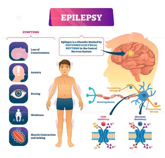 Epilepsy vector illustration