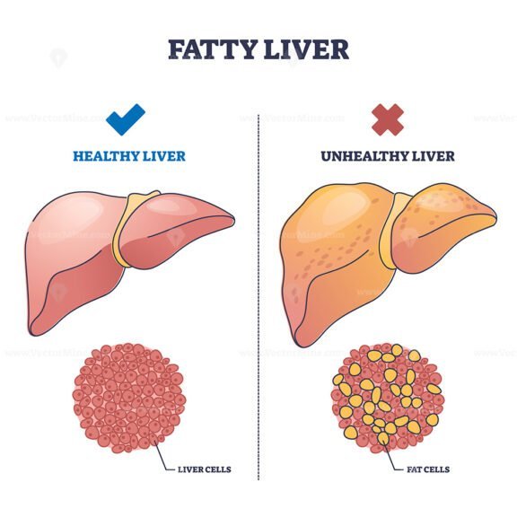 fatty liver outline diagram 1