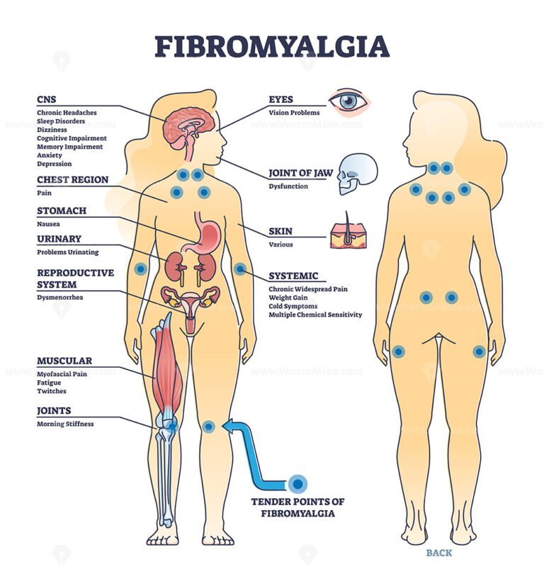 fibromyalgia-as-musculoskeletal-pain-disorder-tender-points-outline