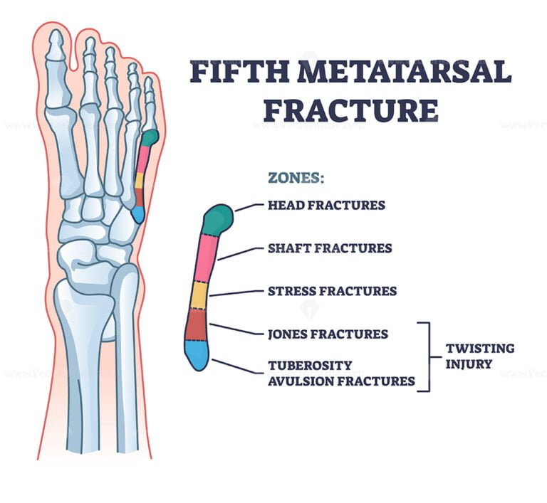 Fifth metatarsal or foot little finger fracture after injury outline ...