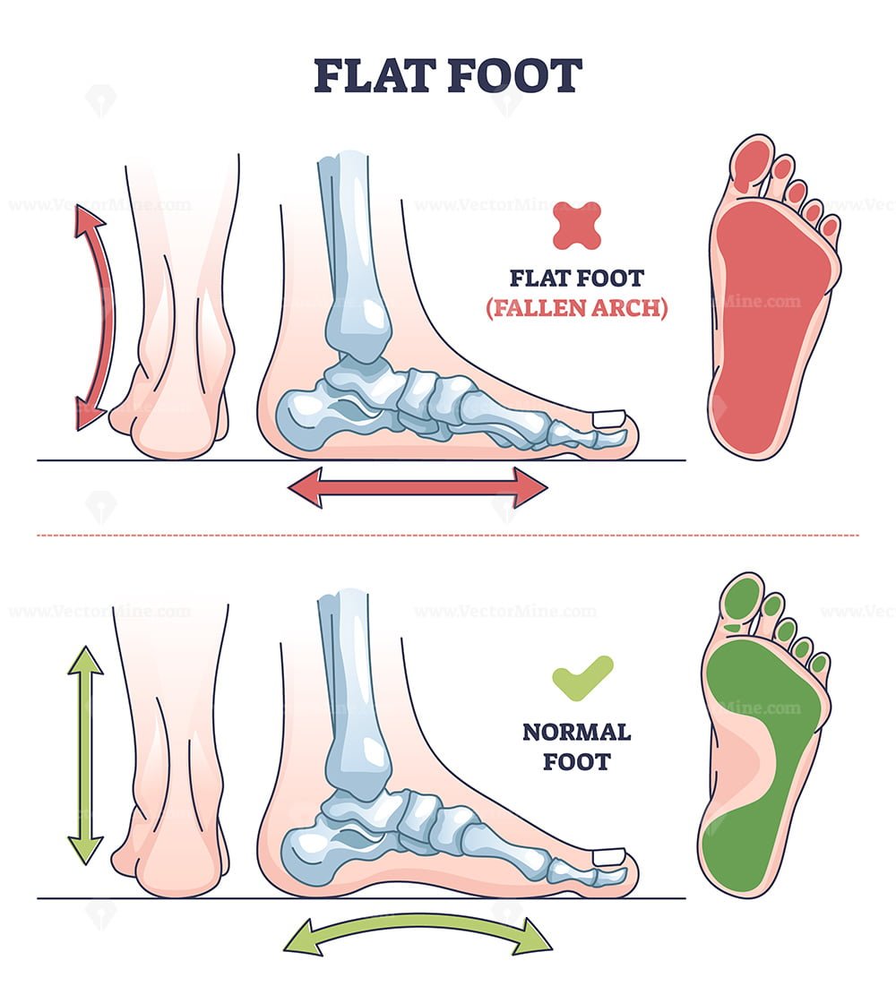 Flat foot pathology with fallen and normal arch comparison outline ...