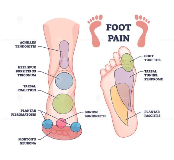 foot-pain-causes-from-zones-diagnosis-and-painful-spots-areas-outline