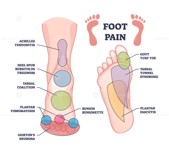 Foot Pain Causes From Zones Diagnosis And Painful Spots Areas Outline 