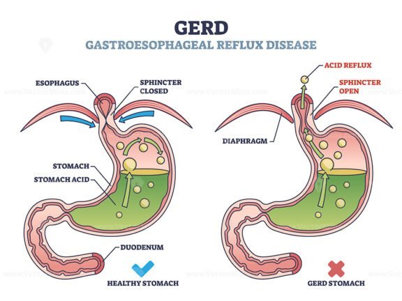 gerd v2 outline 1