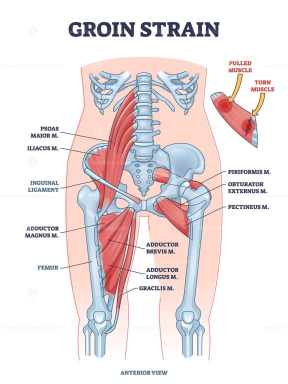 groin strain outline 1