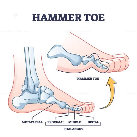 hammer toe outline 1