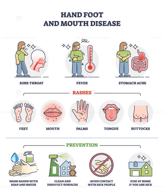 Hand, foot and mouth disease with rashes and how to avoid outline diagram