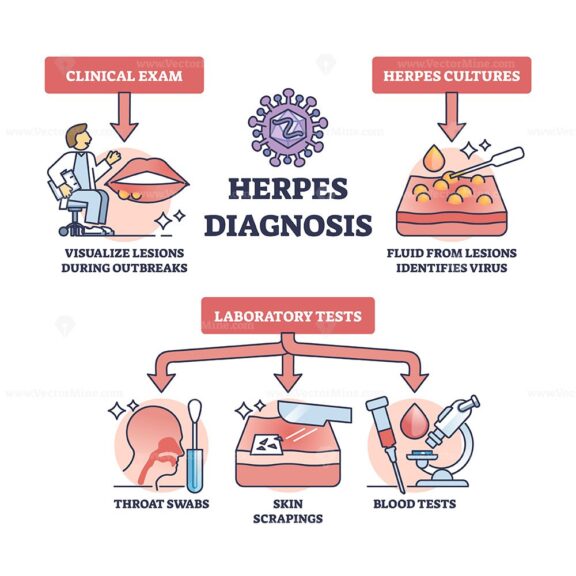 Herpes diagnosis and HSV virus medical diagnosis methods outline ...