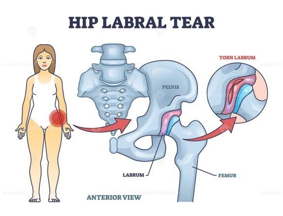 hip labral tear outline diagram 1