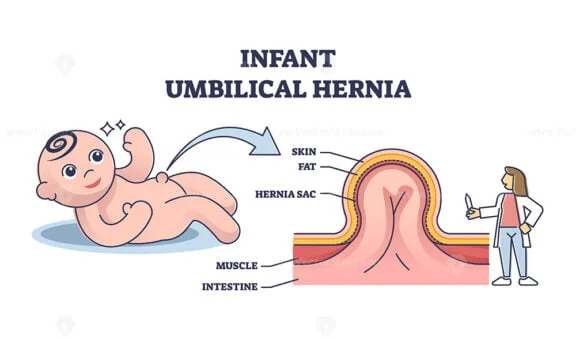 infant umbilical hernia outline diagram 1