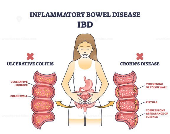 inflammatory bowel disease outline 1