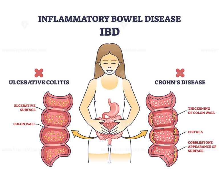 Inflammatory Bowel Disease Or Ibd With Crohns And Colitis Outline Diagram Vectormine 1359