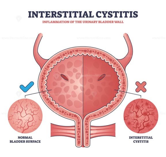 interstitial cystitis outline diagram 1