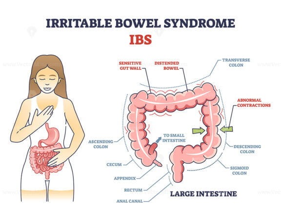 Irritable bowel syndrome or IBS as digestive health problem outline diagram