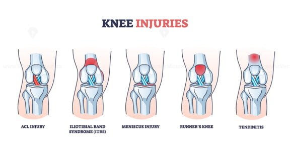 knee injuries outline diagram 1