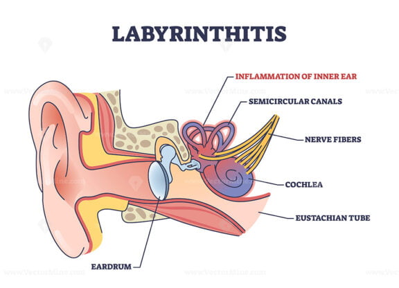 labyrinthitis outline diagram 1