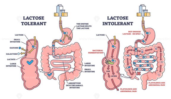 lactose intolerance outline 1