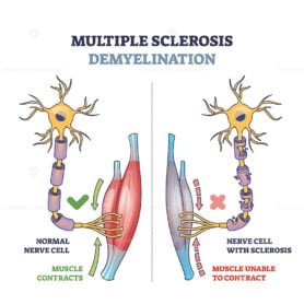 Multiple sclerosis demyelination compared with healthy nerves outline ...