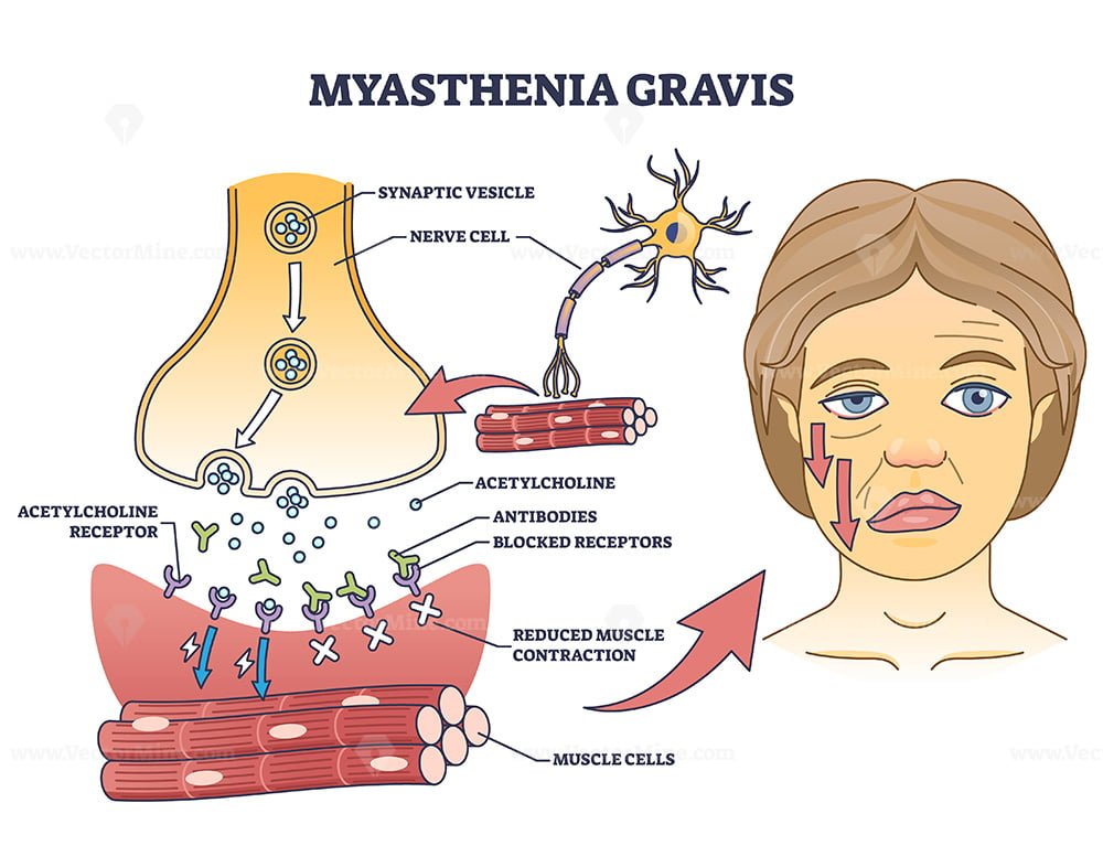 Myasthenia Gravis As Autoimmune Neuromuscular Disease Outline Diagram Vectormine 7510