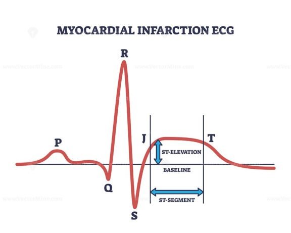 myocardial infarction ecg outline 1
