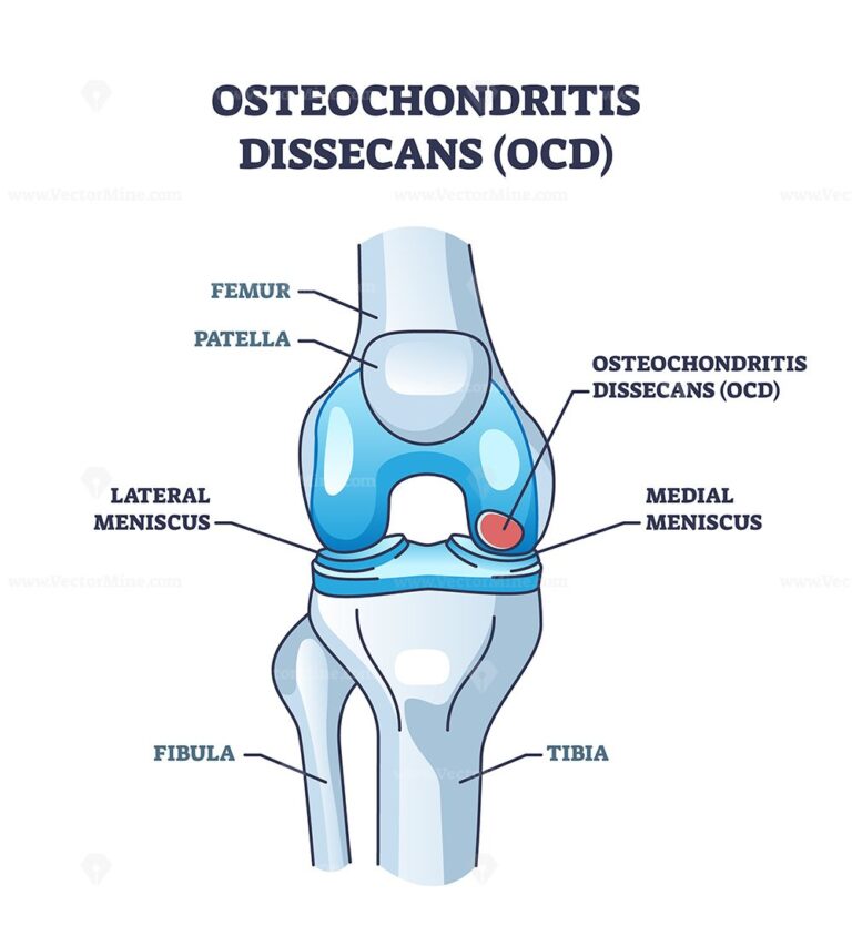 Osteochondritis dissecans or OCD bone and cartilage condition outline ...