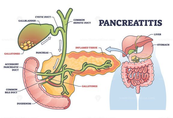 Pancreatitis as pancreas inflammation from chronic gallstones outline ...