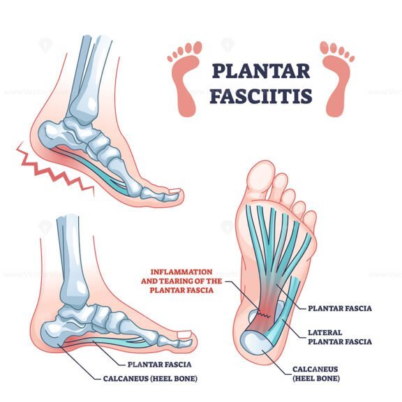 plantar fasciitis outline 1