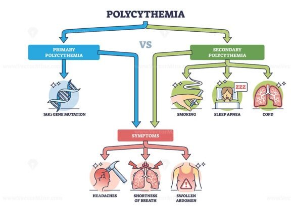 primary vs secondary polycythemia outline 1