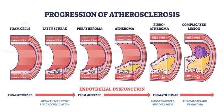 Progression Of Atherosclerosis And Thrombosis Formation Outline Diagram