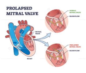 Prolapsed mitral valve heart disease comparison with normal outline ...