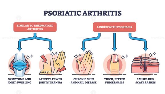 Psoriatic arthritis as chronic dermatological skin condition outline ...