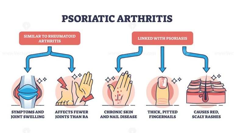 Psoriatic arthritis as chronic dermatological skin condition outline ...