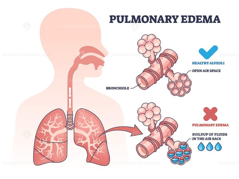 Pulmonary edema condition with fluid buildup in air sacs outline ...