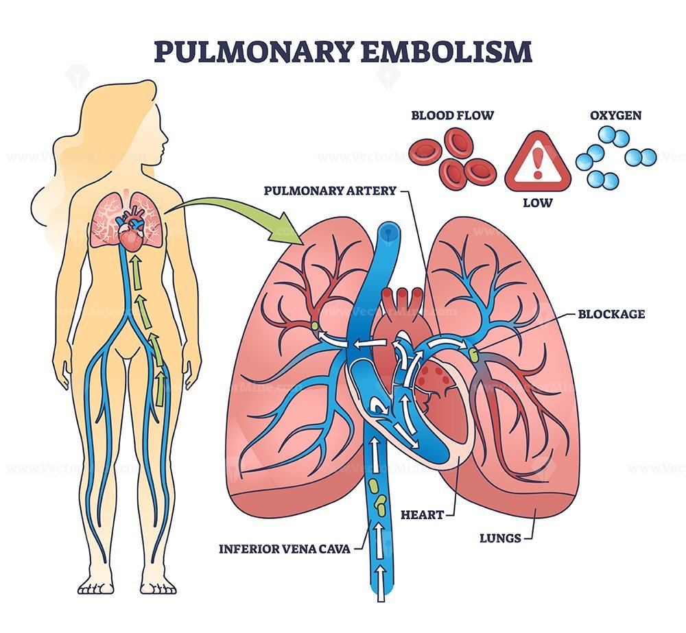 Pulmonary embolism with blood flow blockage in lung artery outline ...