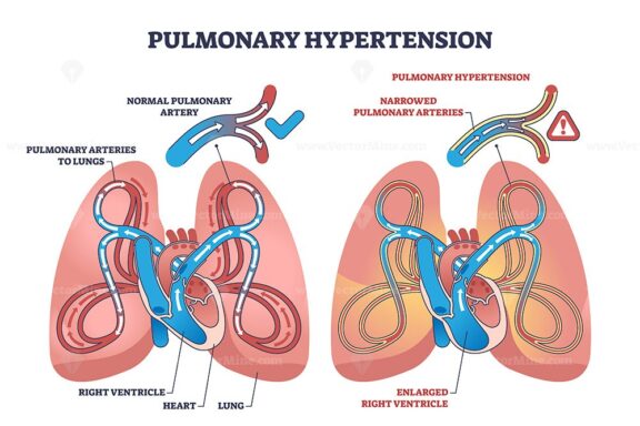 Pulmonary hypertension with narrow arteries and blockage outline ...