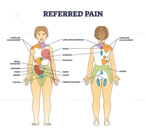 referred pain outline diagram 1