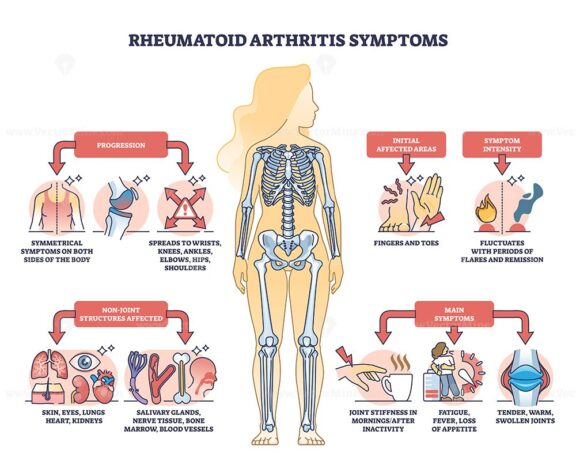 Rheumatoid arthritis symptoms with joint inflammation disease outline ...