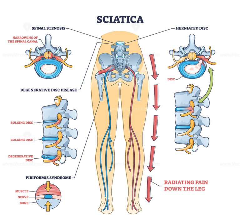 Sciatica vs piriformis medical muscle conditions comparison outline ...