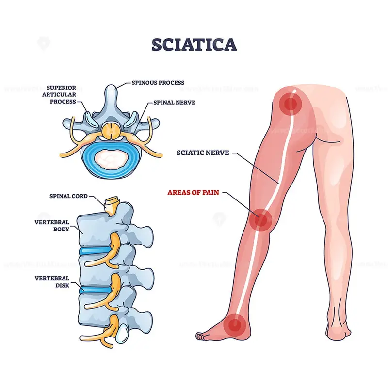 Sciatica as symptom from herniated disc and spinal nerve outline diagram –  VectorMine