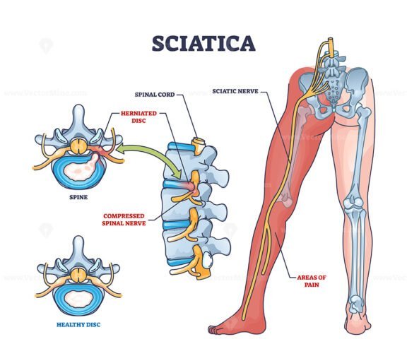 Sciatica As Symptom From Herniated Disc And Spinal Nerve Outline ...