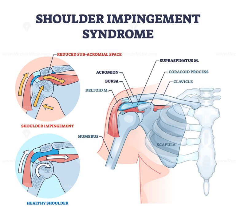 Shoulder impingement syndrome from rubbing rotator cuff outline diagram ...