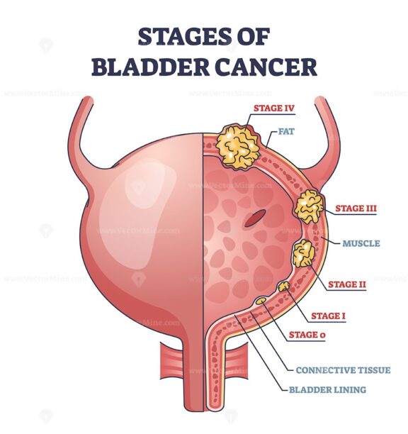 Stages of bladder cancer with anatomical oncology model outline diagram