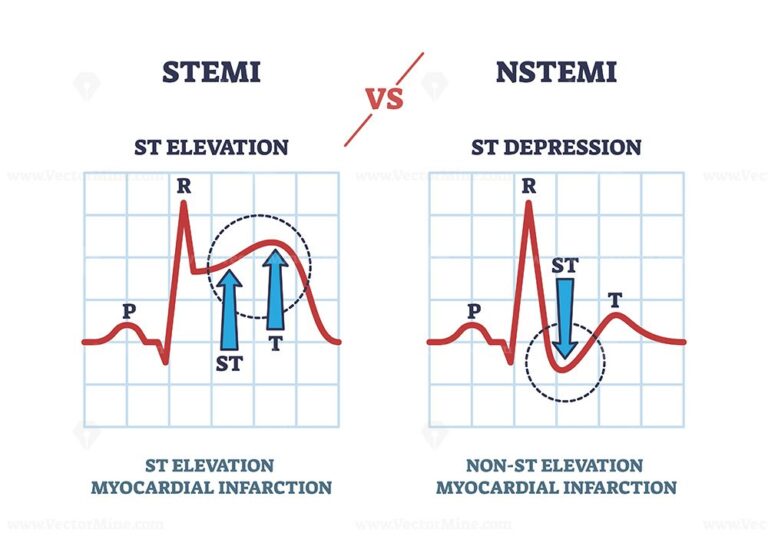 STEMI vs NSTEM heart beat impulse in cardio visualization outline ...