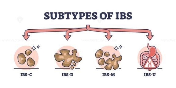 subtypes of ibs outline 1