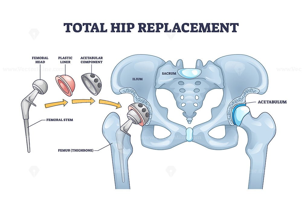 Total hip replacement surgery with acetabular prosthesis outline ...