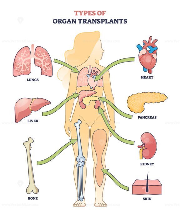 types of organ transplants outline diagram 1