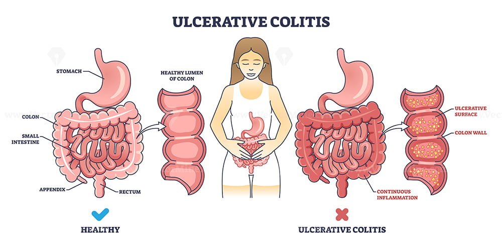 Ulcerative Colitis As Chronic Inflammatory Bowel Disease Outline ...