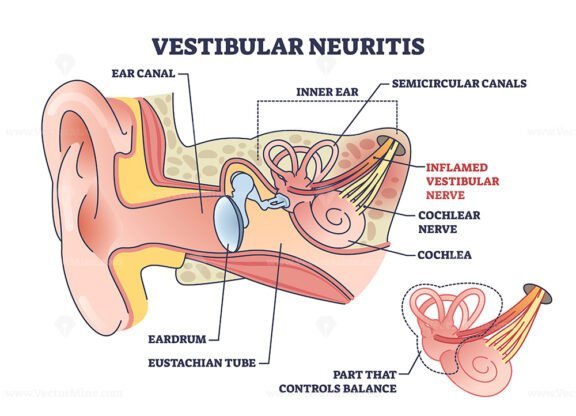 vestibular neuritis outline diagram 1
